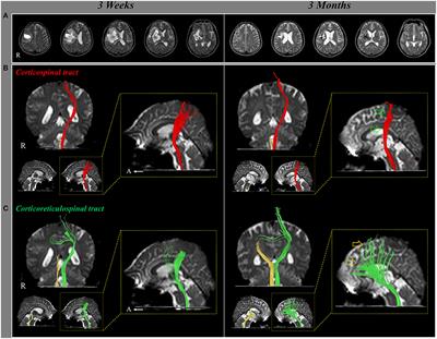 Role of the Contra-Lesional Corticoreticular Tract in Motor Recovery of the Paretic Leg in Stroke: A Mini-Narrative Review